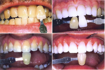 different types of laser teeth whitening