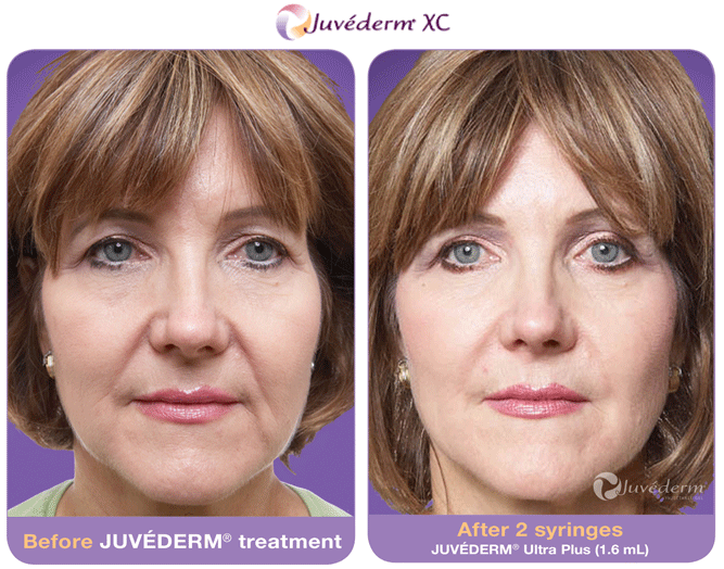 Before and After Juvederm Treatment, in New Orleans, LA 70115
