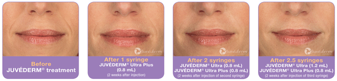 Juvederm Treatment before and after photos, New Orleans, LA 70115